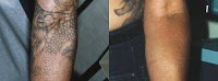 The Tattoo Removal Experts 377743 Image 3